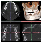 歯科用CT撮影画像