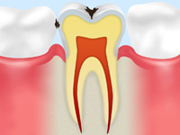 C1（エナメル質レベルの虫歯）