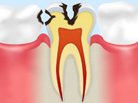 C2（象牙質レベルの虫歯）