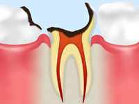 C4（歯根レベルの虫歯）